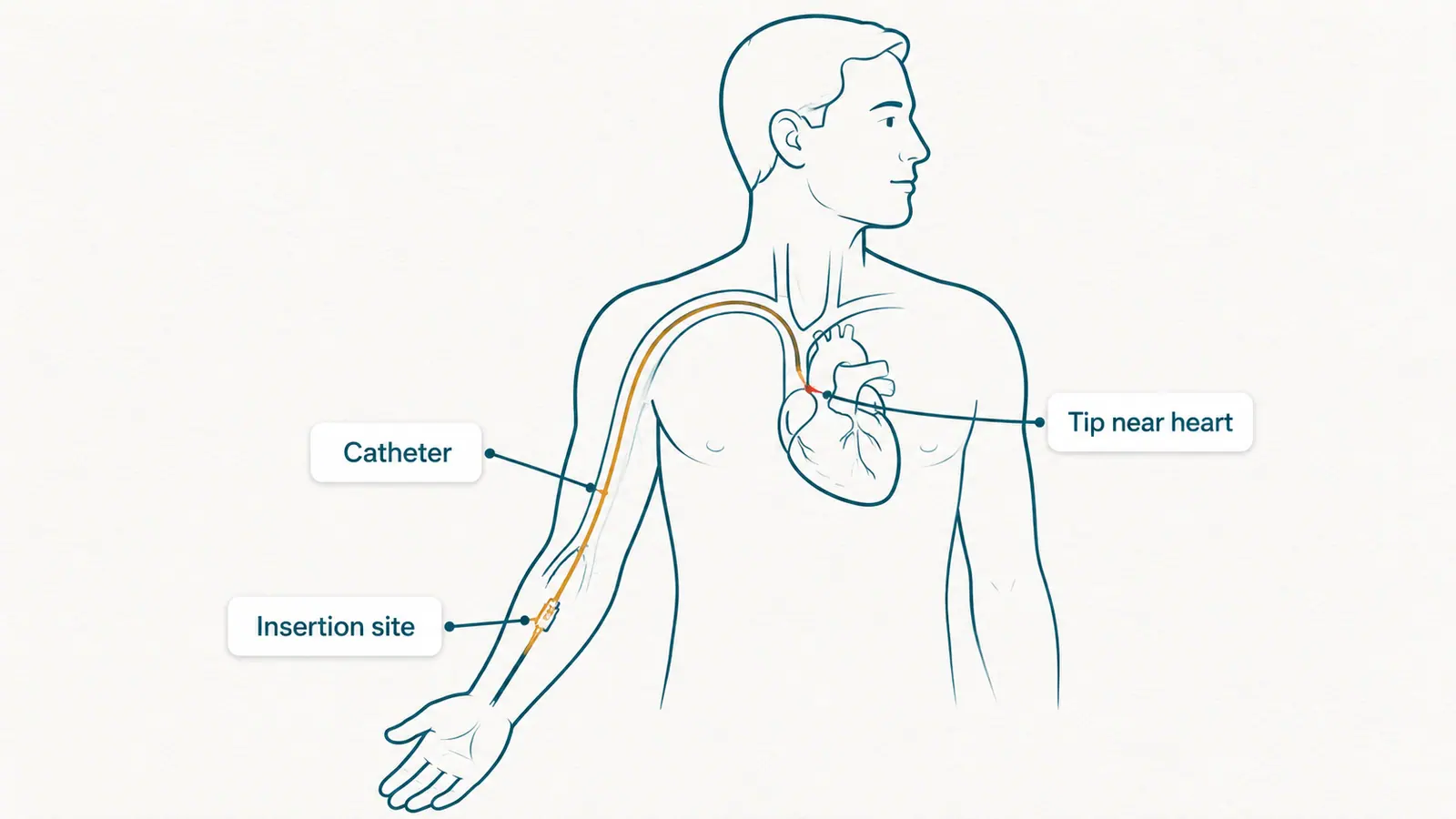 PICC line anatomy diagram showing insertion from the upper arm to a large vein near the heart