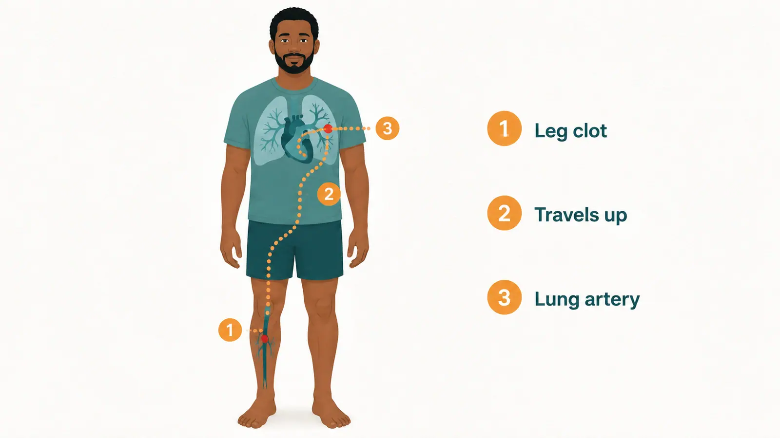 插图 1 · How a leg clot becomes a lung clot