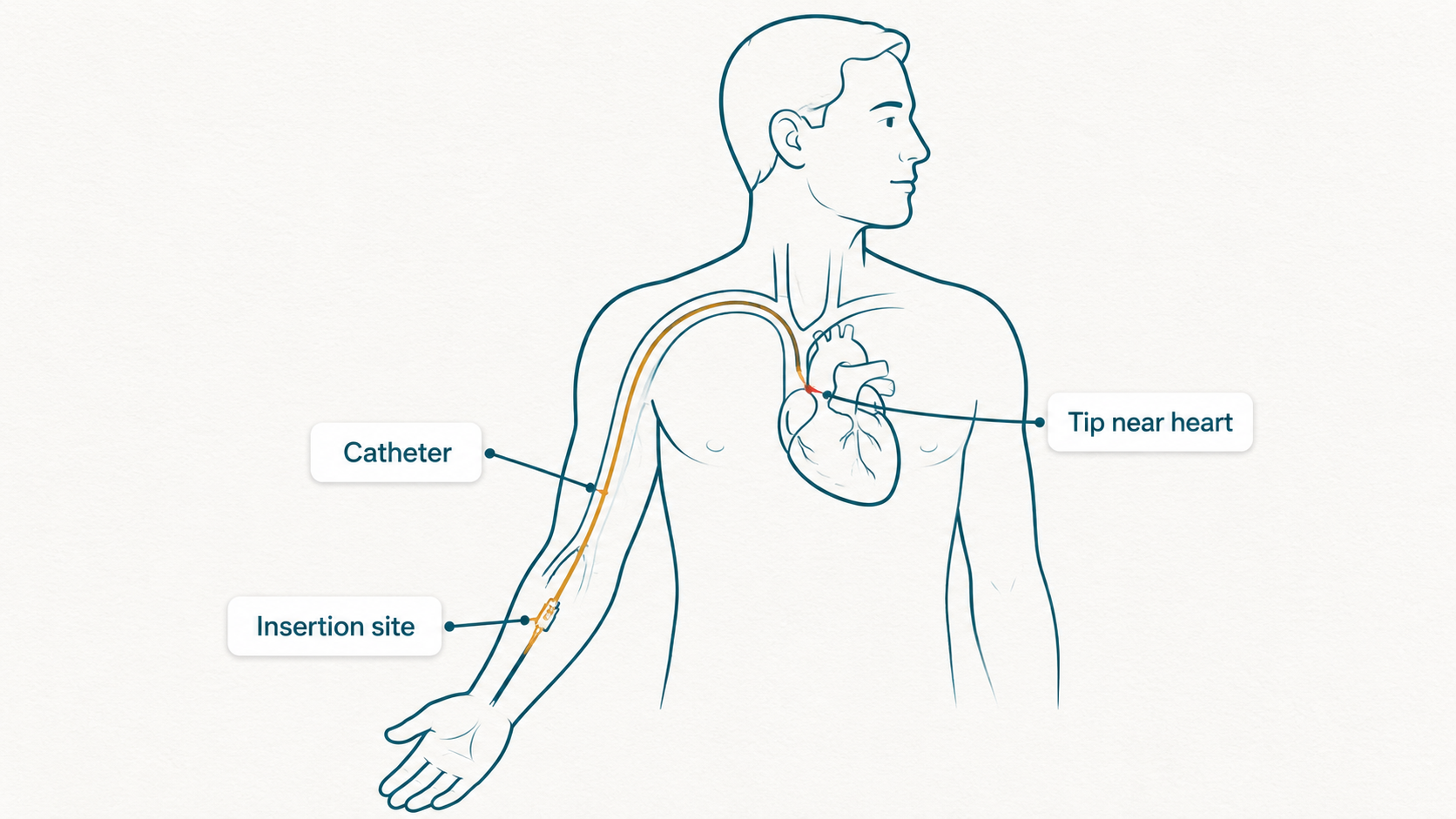 PICC line anatomy diagram showing insertion from the upper arm to a large vein near the heart
