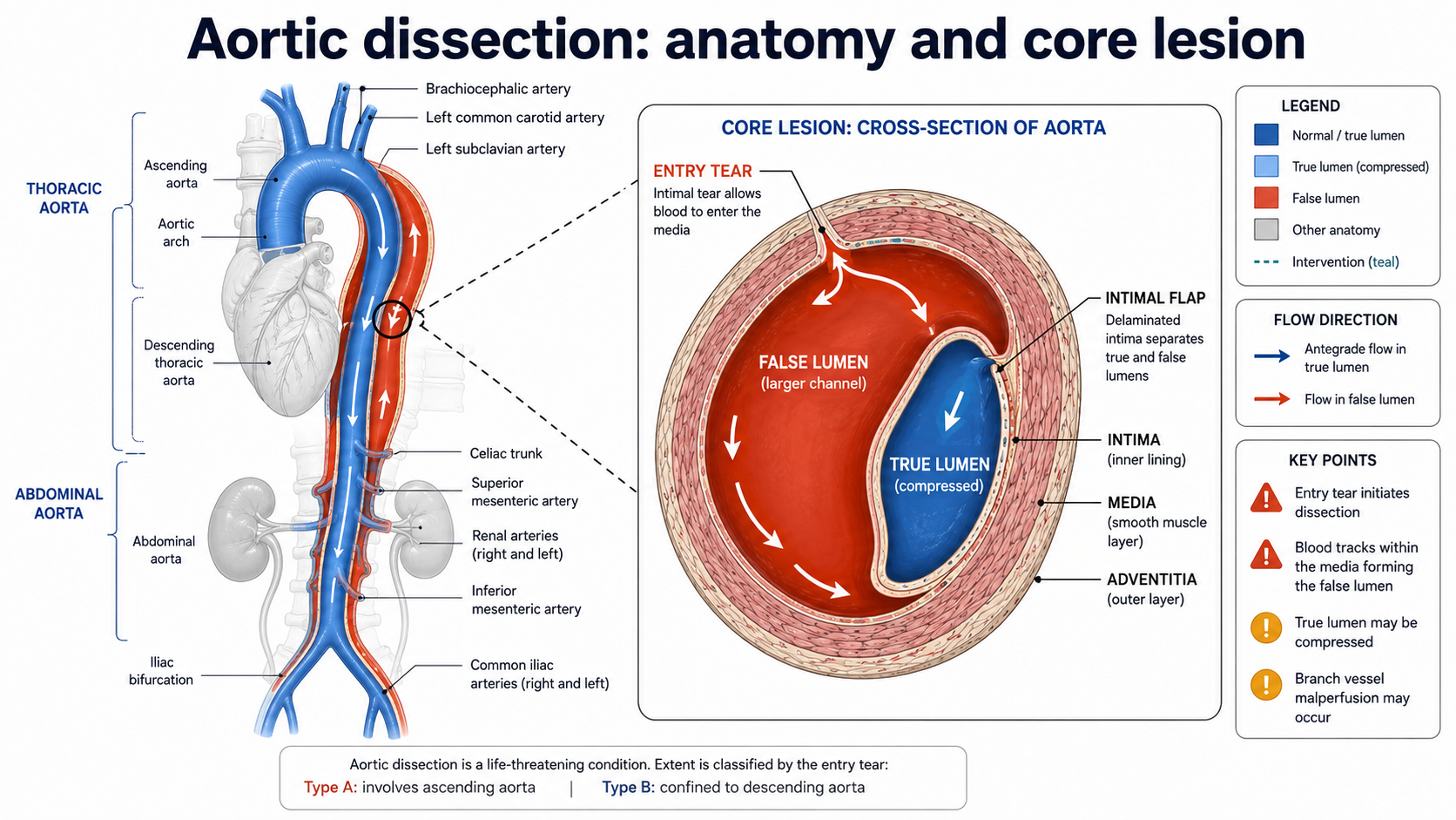 Figure 1: Normal aortic anatomy, wall layers, entry tear, true lumen and false lumen