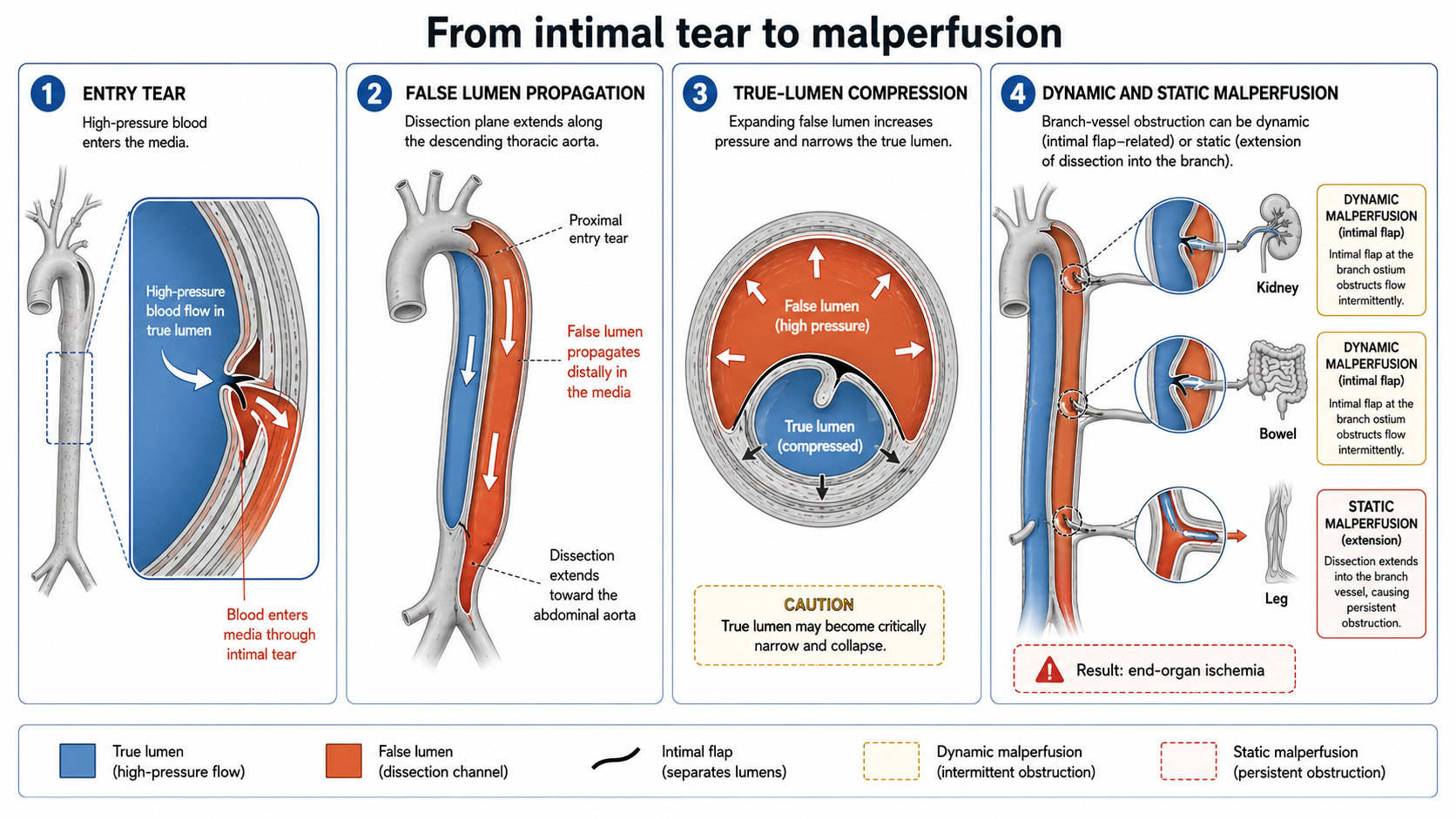 Figure 3: Four-step pathophysiology of true-lumen compression, false-lumen pressurization and branch-vessel malperfusion