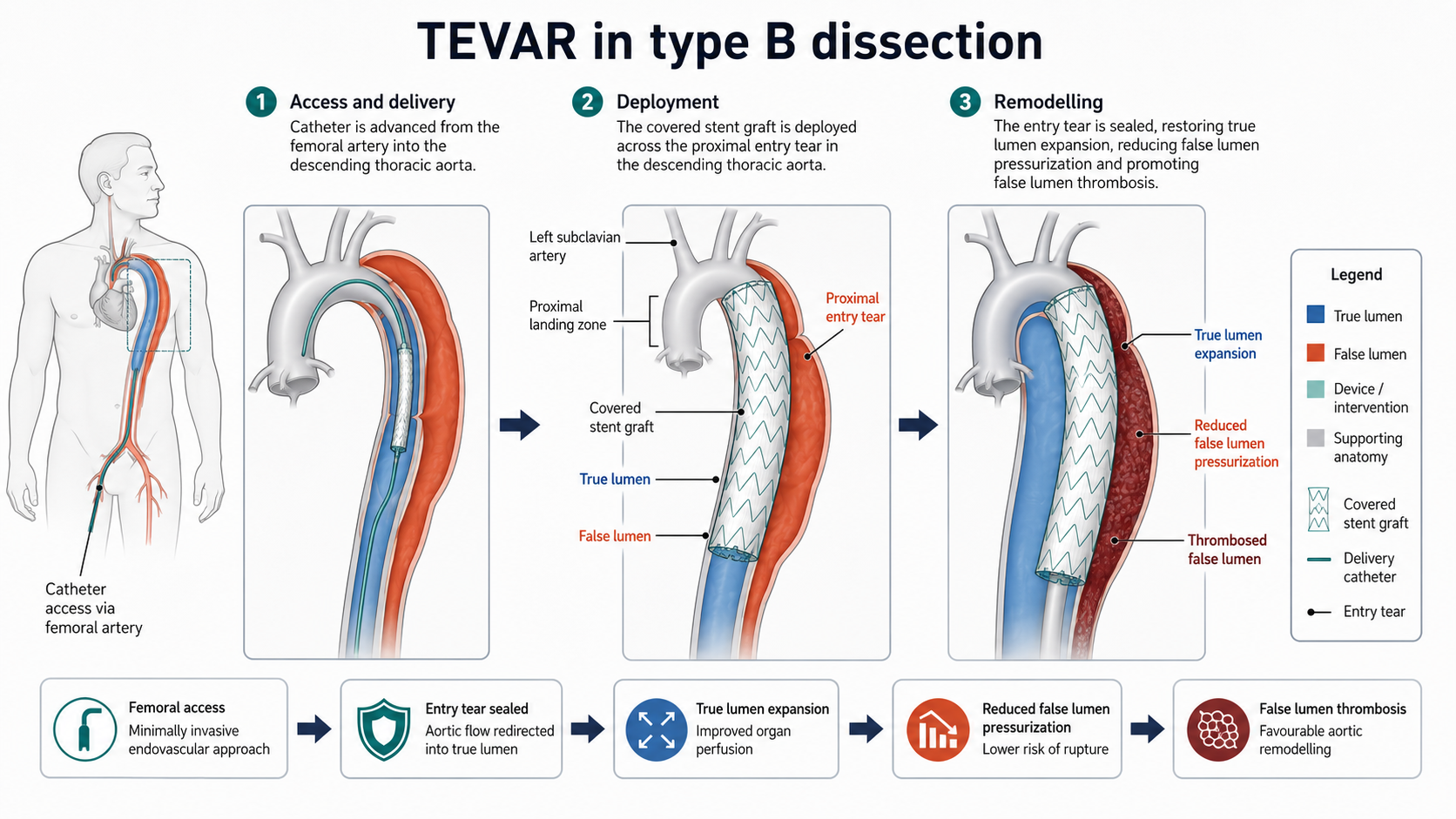 Figure 9: TEVAR mechanism: proximal entry coverage, true-lumen expansion and false-lumen thrombosis