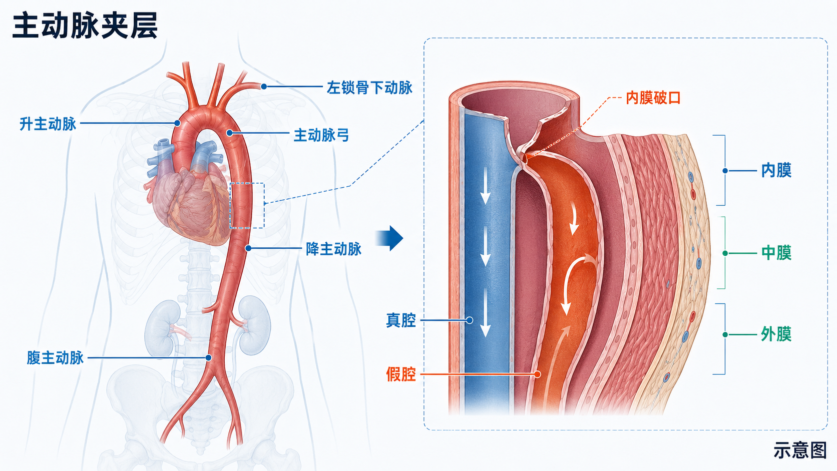 图1｜主动脉夹层概念与解剖总览