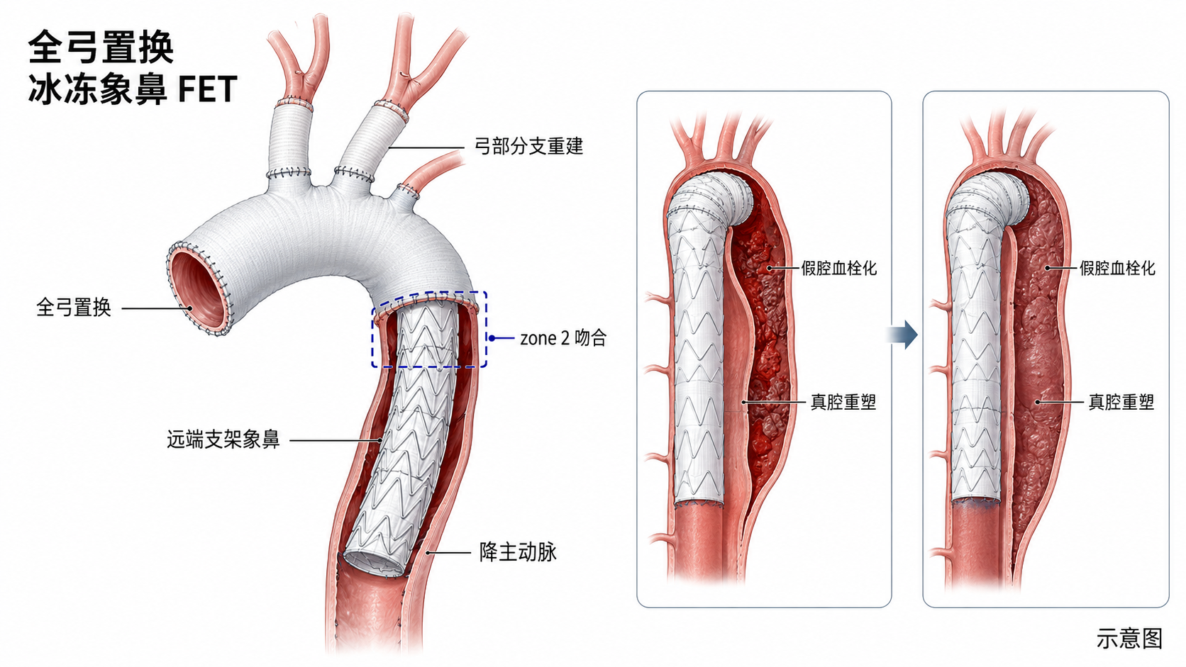 图10｜冰冻象鼻 FET 手术示意图