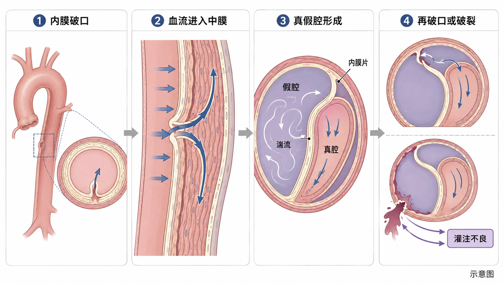 图2｜真假腔形成与病理机制连续图