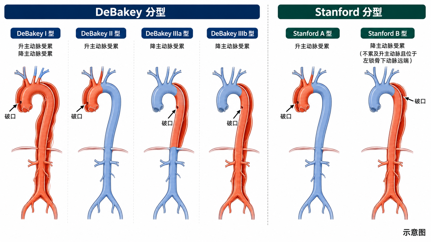 图3｜DeBakey 与 Stanford 分型对照图