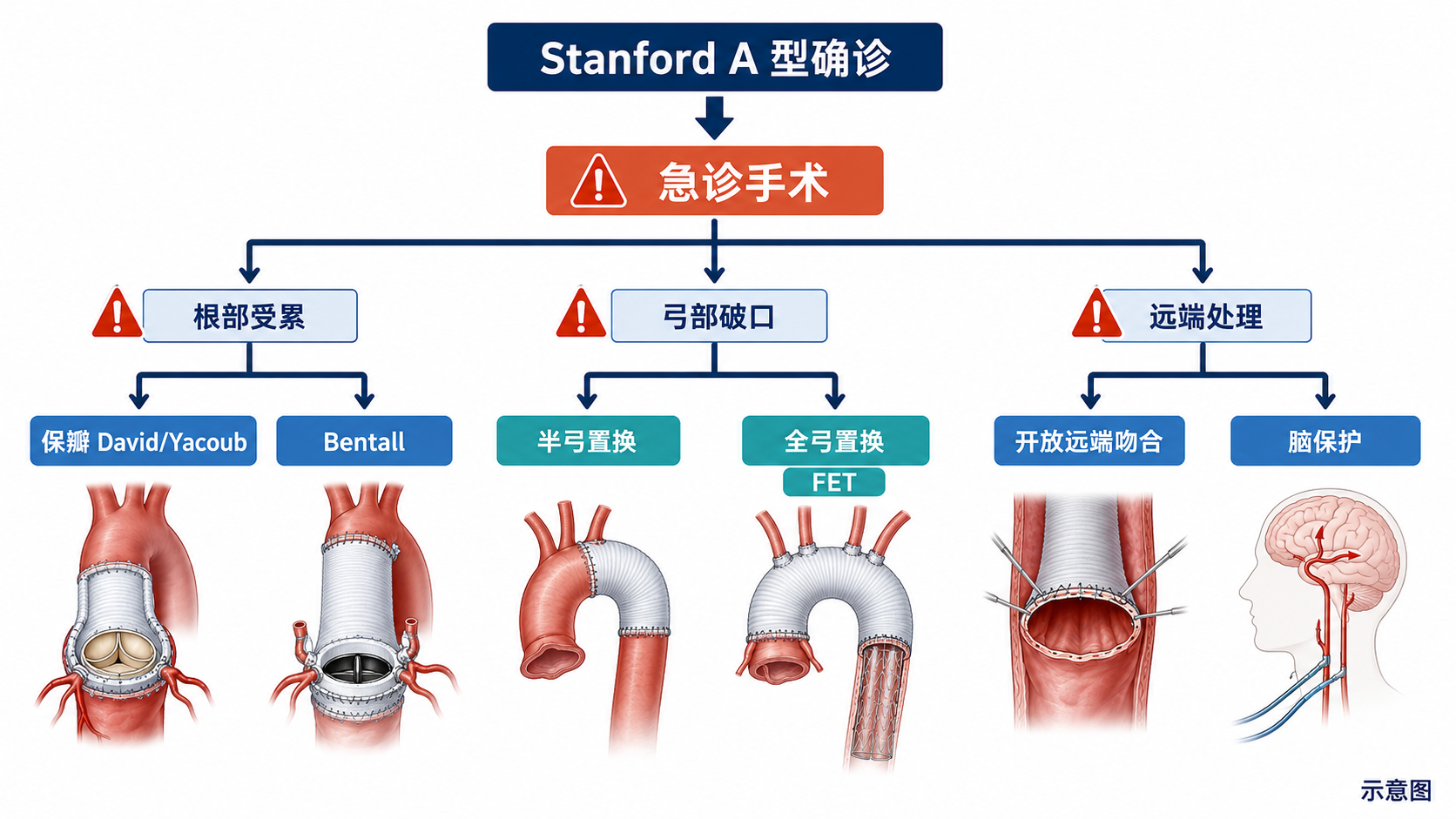 图7｜Stanford A 型外科治疗决策树